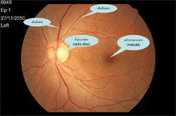ภาพแสดงจอประสาทตาปรกติของตาซ้าย
