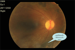 ภาพแสดงจอประสาทตาของผู้ที่เป็นเบาหวานขึ้นจอประสาทตา