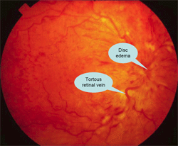 ภาพแสดงเส้นเลือดดำจอประสาทตาอุดตัน