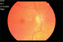 ภาพแสดงจอประสาทตาปรกติตาขวา
