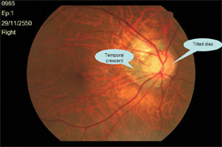 แสดงจอประสาทตาของผู้ที่มีสายตาสั้นมาก