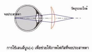 สายตายาวผู้สูงอายุ ( Presbyopia )