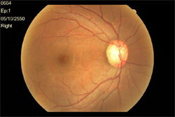 ภาพแสดงการเปลี่ยนแปลงของขั้วประสาทตาในโรคต้อหิน 