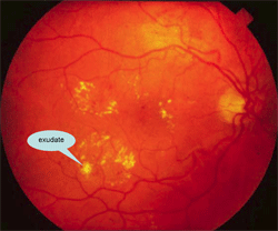 เบาหวานที่จอประสาทตาระยะแรก