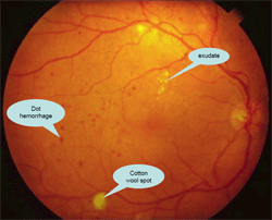 เบาหวานที่จอประสาทตาระยะกลาง