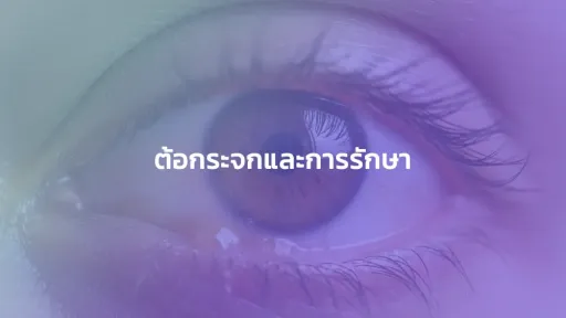 ต้อกระจกและการรักษา