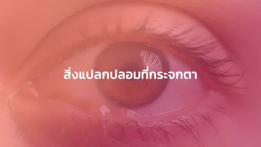 สิ่งแปลกปลอมที่กระจกตา