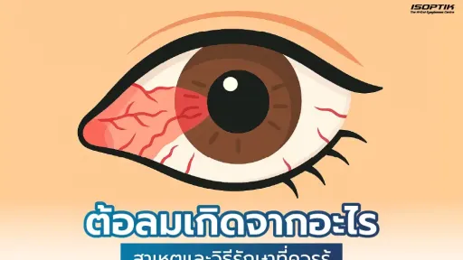 ต้อลมเกิดจากอะไร รวมสาเหตุและวิธีรักษาที่ควรรู้