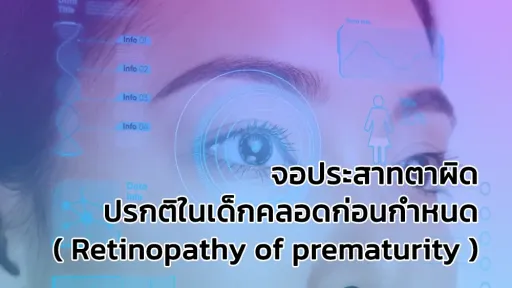 จอประสาทตาผิดปรกติในเด็กคลอดก่อนกำหนด ( Retinopathy of prematurity )