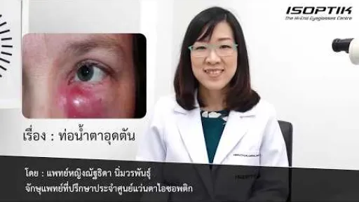 สุขภาพสายตา " ท่อน้ำตาอุดตัน "  - โดย แพทย์หญิง ณัฐธิดา นิ่มวรพันธุ์