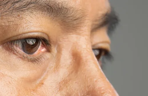  โรคจอประสาทตาเสื่อม