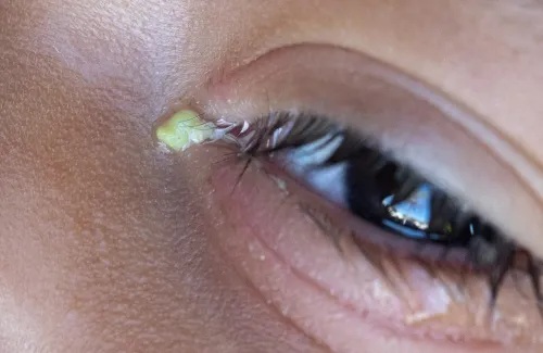 สาเหตุของขี้ตาเยอะ