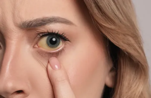 ตาขาวเหลืองเกิดจากสาเหตุอะไร