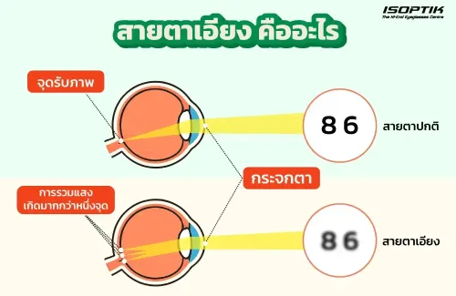 สายตาเอียง ( Astigmatism ) คืออะไร
