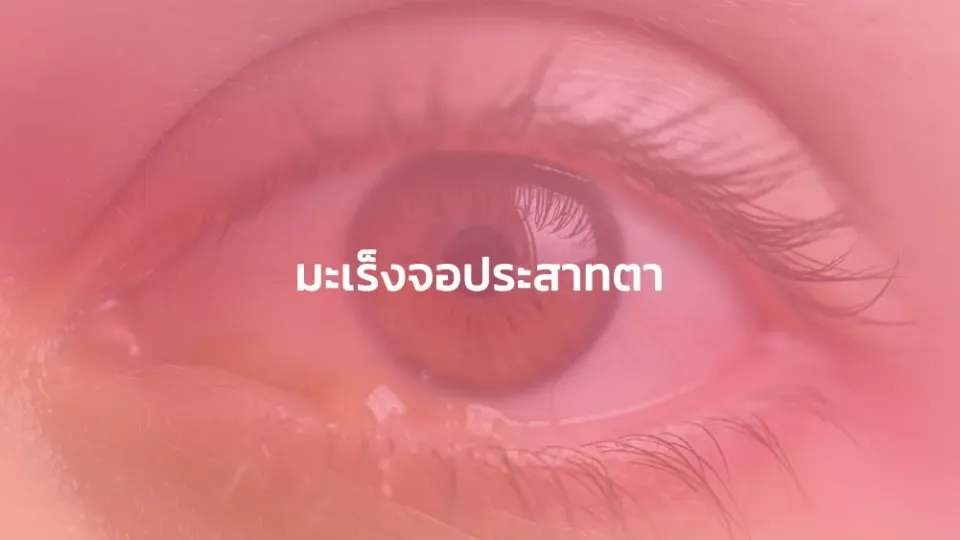 มะเร็งจอประสาทตา