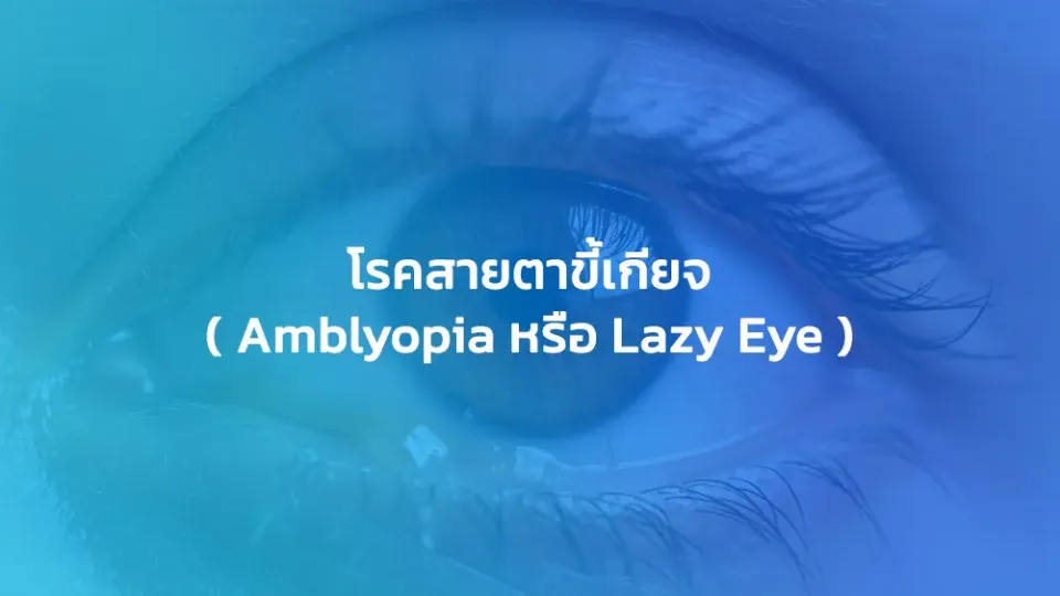 โรคสายตาขี้เกียจ ( Amblyopia หรือ Lazy Eye )