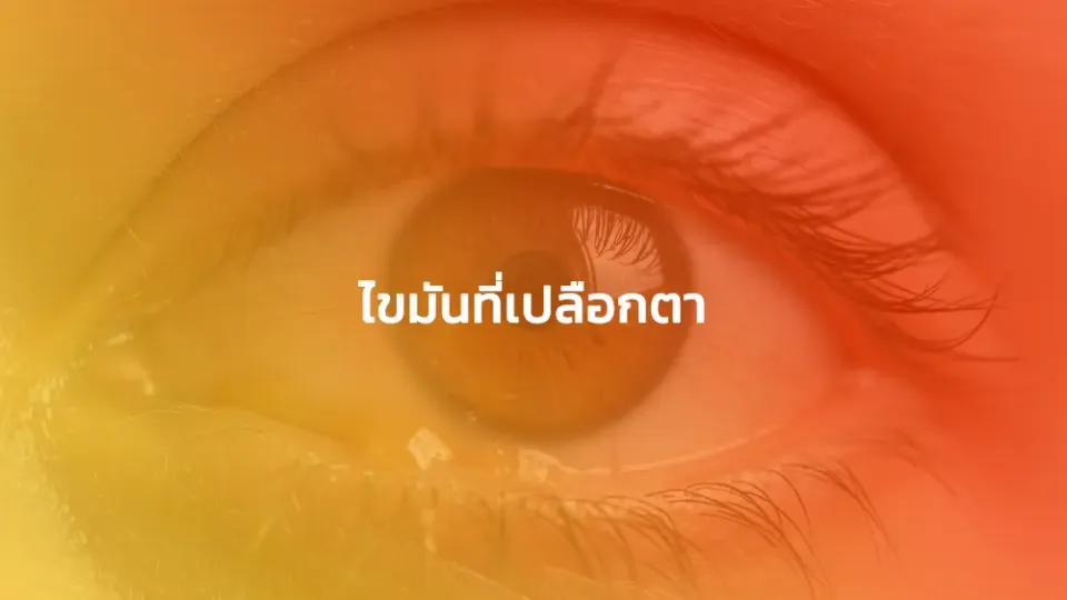 ไขมันที่เปลือกตา