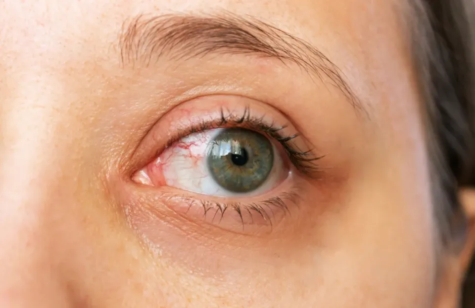 เส้นเลือดฝอยในตาแตกเกิดจากอะไร