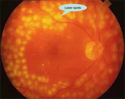 จอประสาทตา