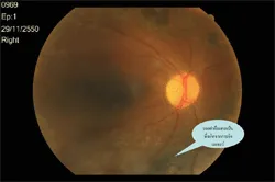 จอประสาทตา