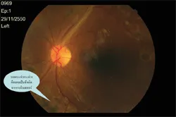 จอประสาทตา