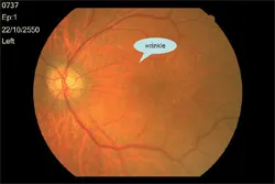 จอประสาทตา