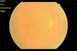 จอประสาทตา