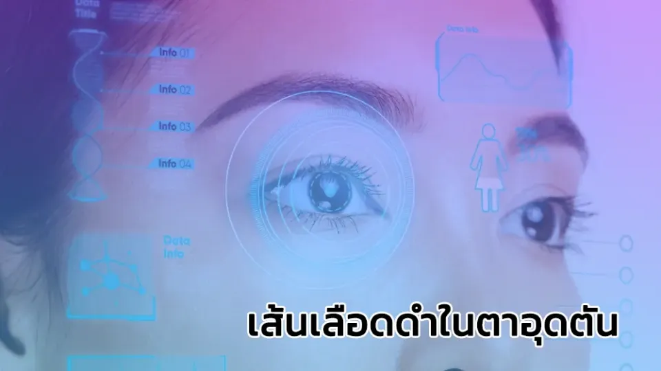 เส้นเลือดดำในตาอุดตัน