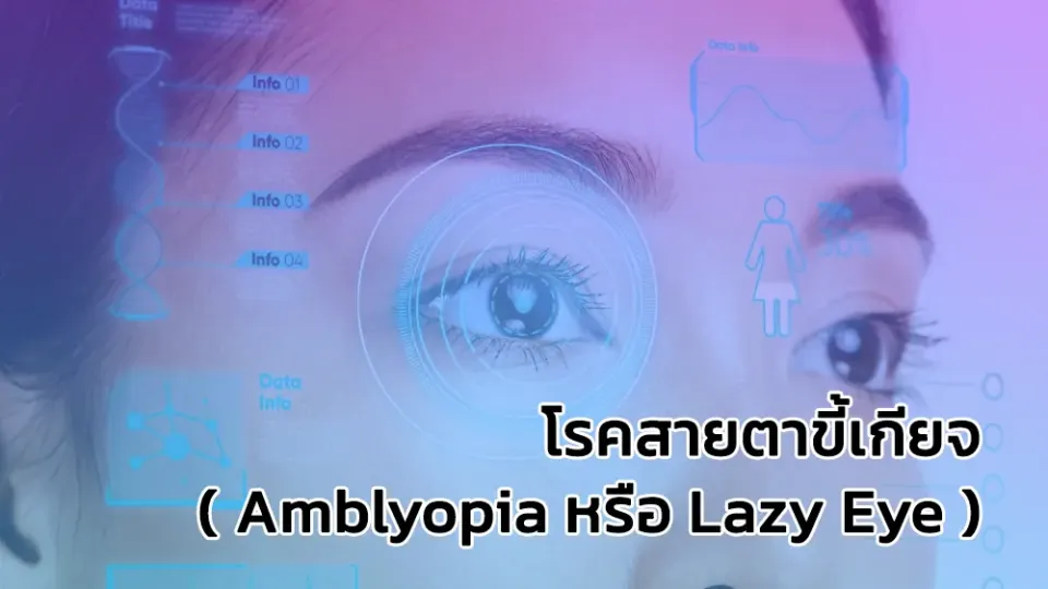 โรคสายตาขี้เกียจ ( Amblyopia หรือ Lazy Eye )