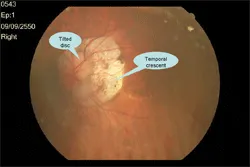 จอประสาทตา