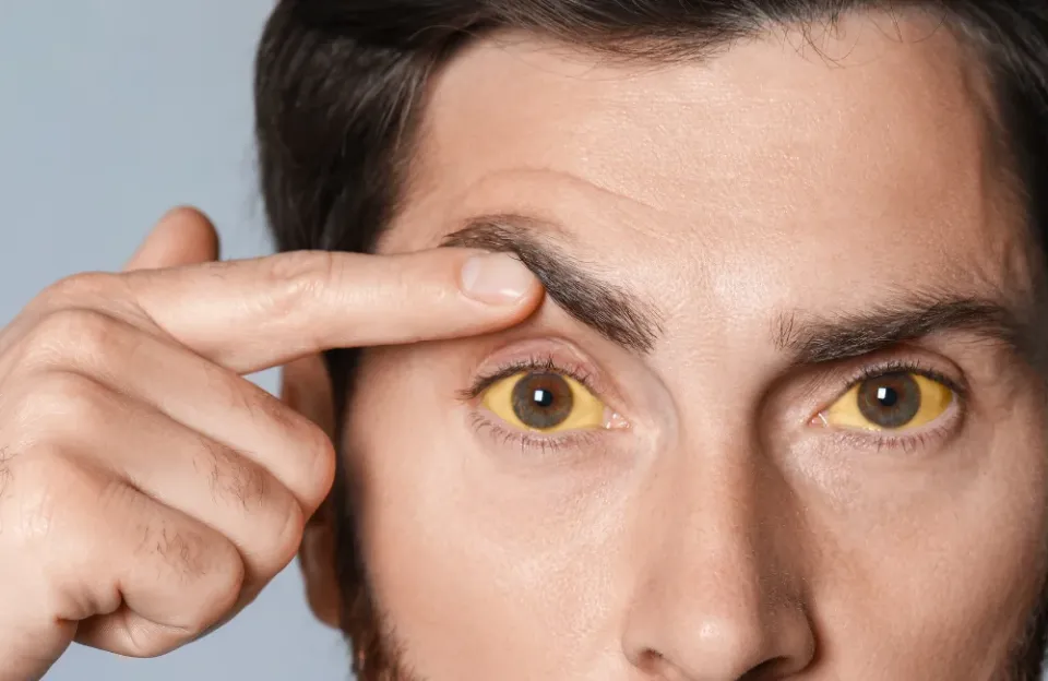 ตาขาวเหลืองเกิดจากอะไร อาการแบบไหนควรพบแพทย์