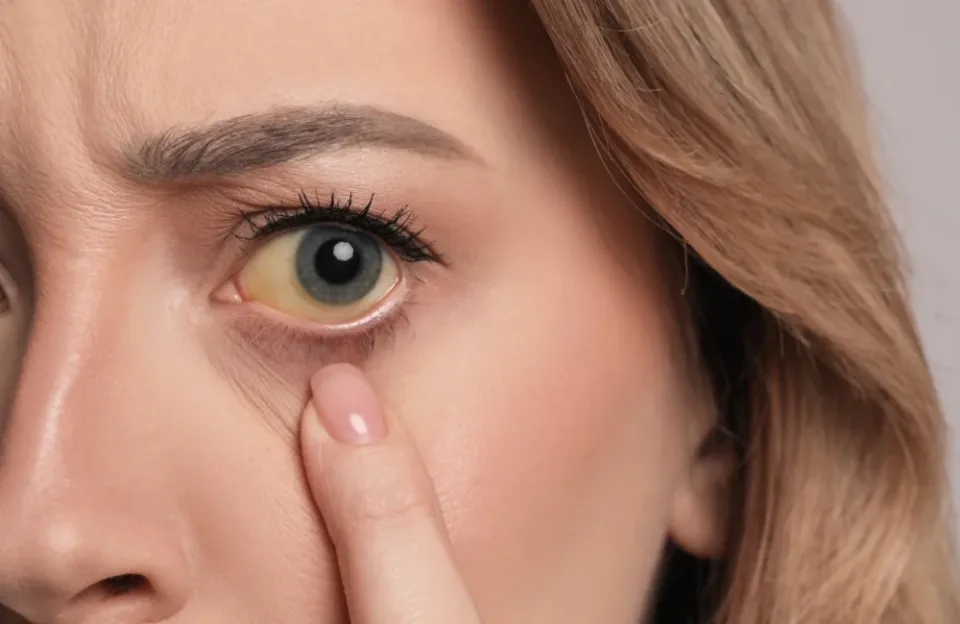 ตาขาวเหลืองเกิดจากสาเหตุอะไร